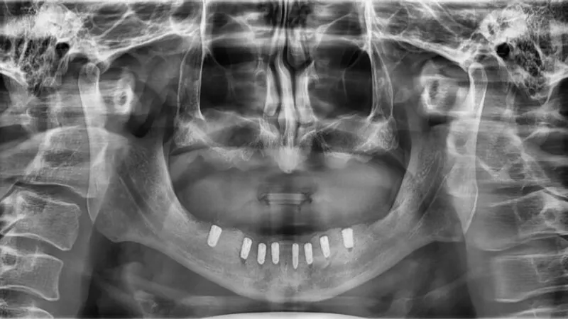 After 8 months of dental implant treatment