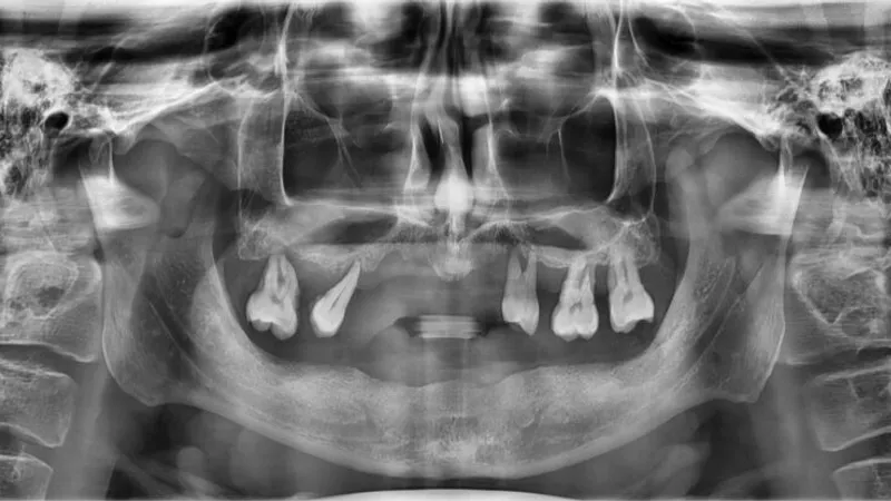 Before implant treatment for tooth loss caused by periodontitis