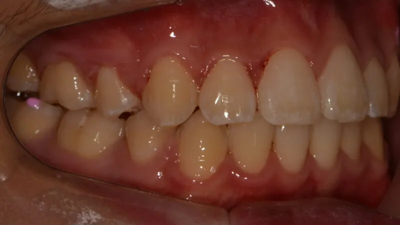 After 22 months of orthodontic treatment for open bite