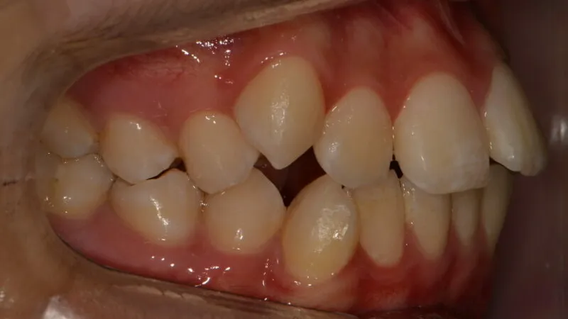 Before orthodontic treatment for open bite