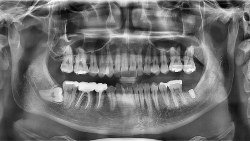 After 3 weeks of root canal treatment