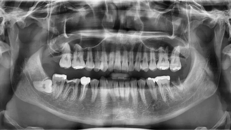 Before root canal treatment for a decayed tooth